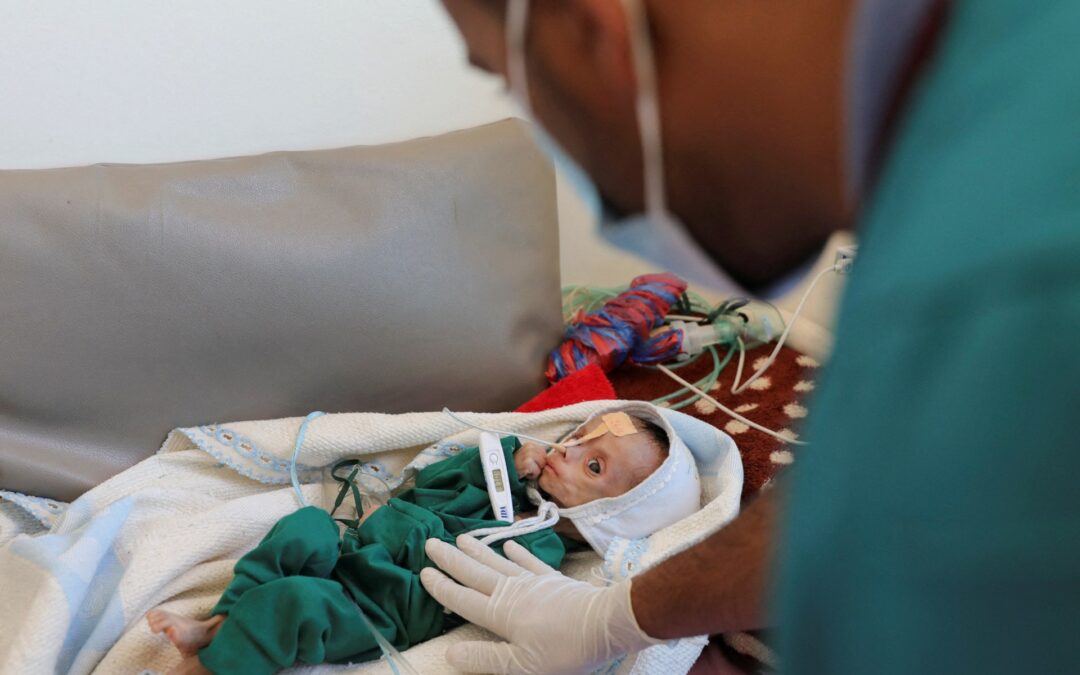 Hunger is looming over Yemen, urgent action is needed