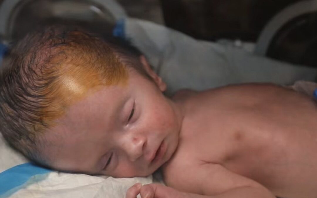 Gaza’s unseen casualties: A surge in stillbirths and birth defects